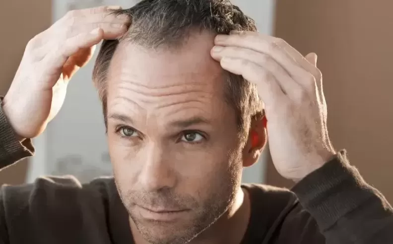 Main Cause of Male Baldness