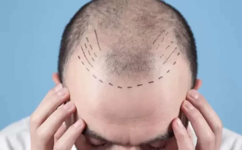 Effective Treatments for Baldness