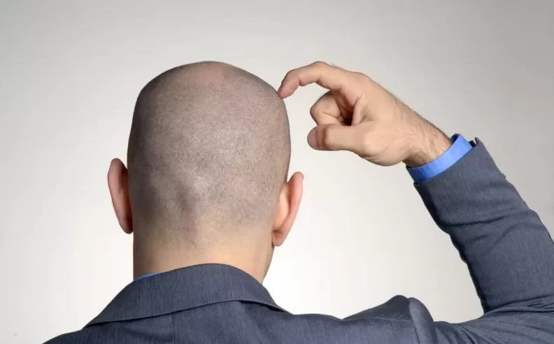 Other Causes of Hair Loss in Men