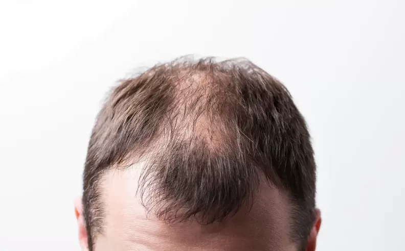 Causes of Thinning Hair in Men